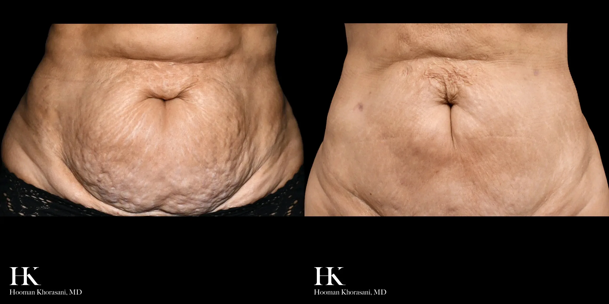 Abdominal skin tightening clinical before and after - Hooman Khorasani MD