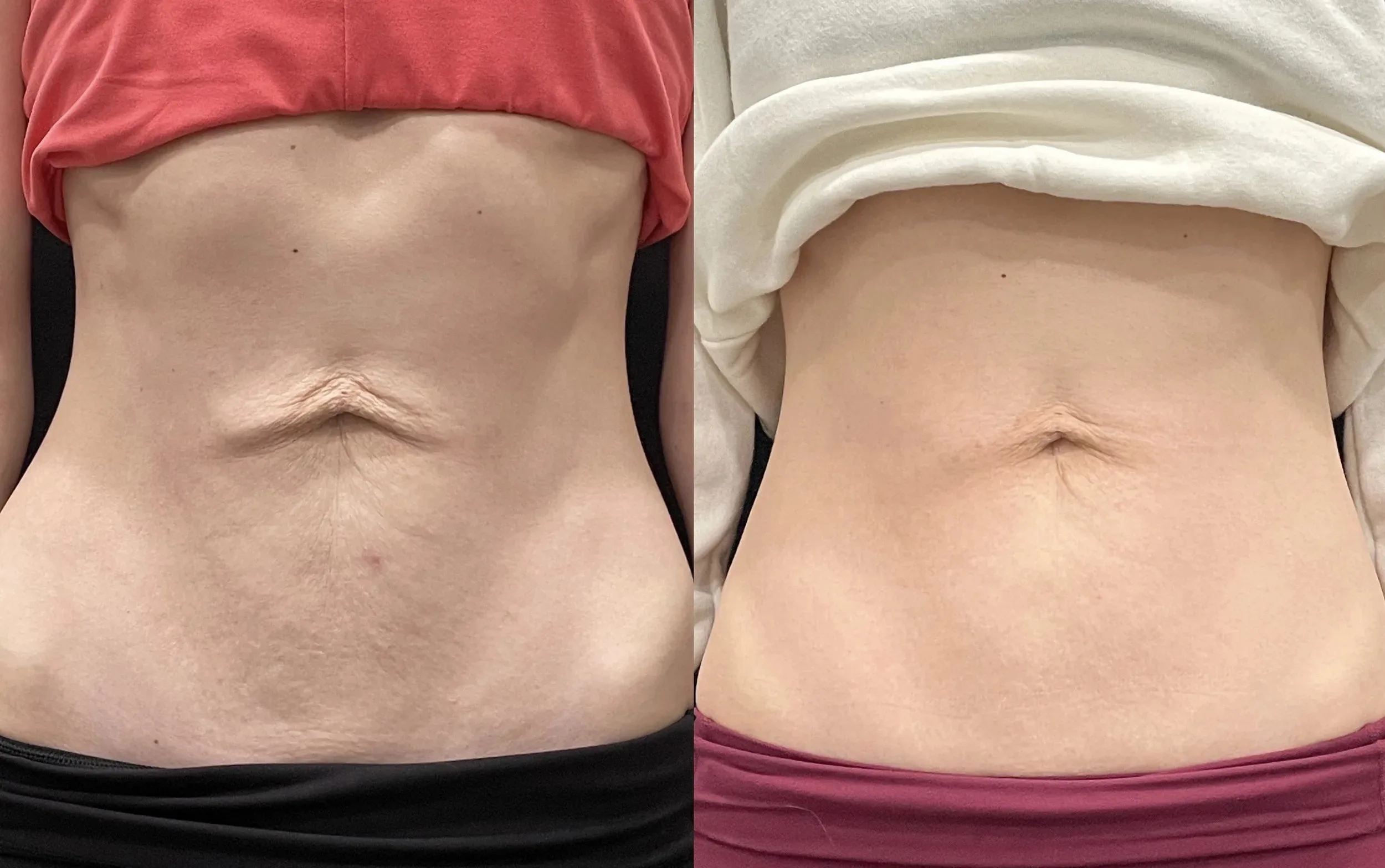 XERF abdomen before and after - loose skin tightening