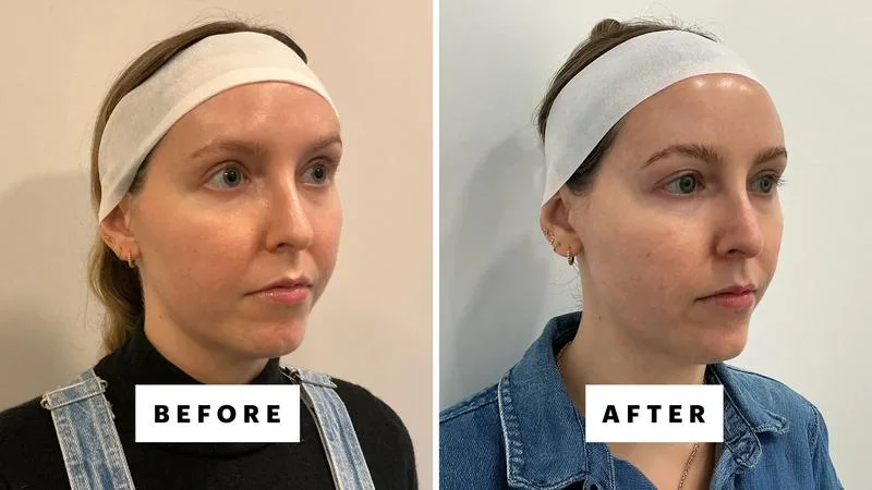 XERF jawline definition before and after — featured in Allure