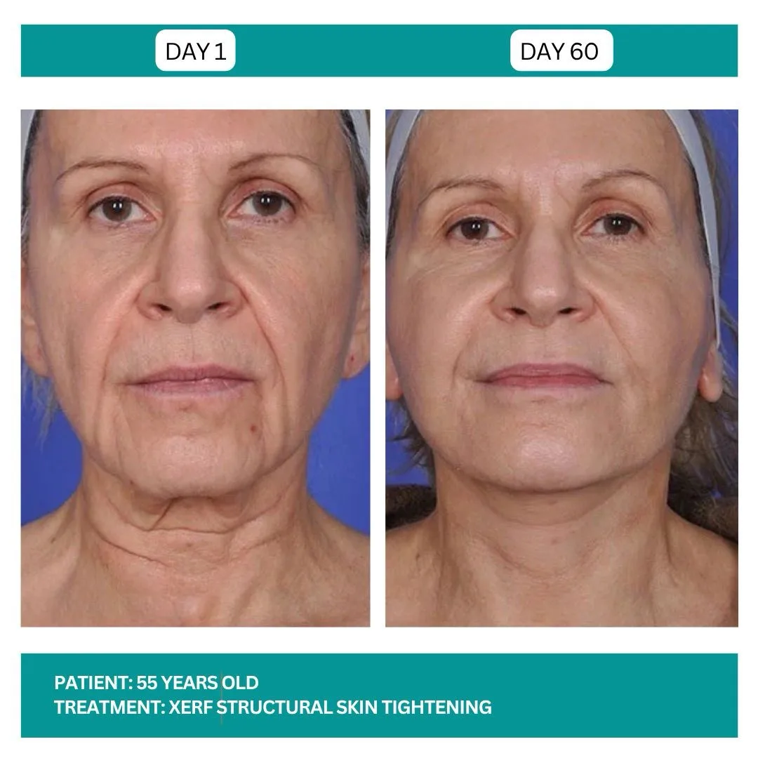 XERF full face before and after - 55-year-old patient at Day 1 and Day 60