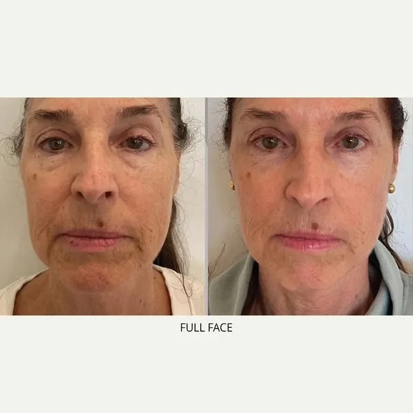 XERF full face lifting and tightening after 2 sessions