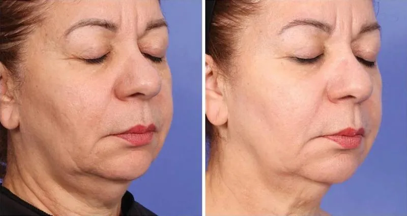 XERF jowl reduction and jawline definition — Cynosure clinical results
