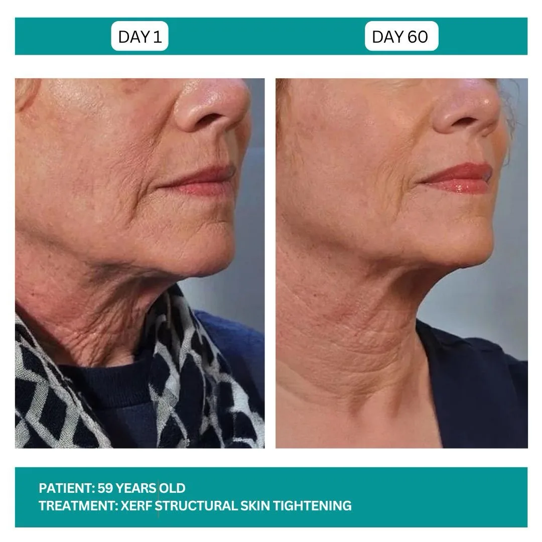 XERF jowl and neck before and after - 59-year-old patient at Day 1 and Day 60