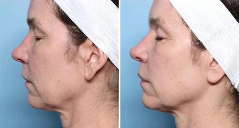 XERF neck and jawline tightening before and after
