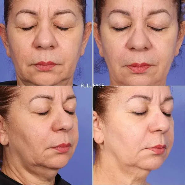 XERF face tightening before and after side profile