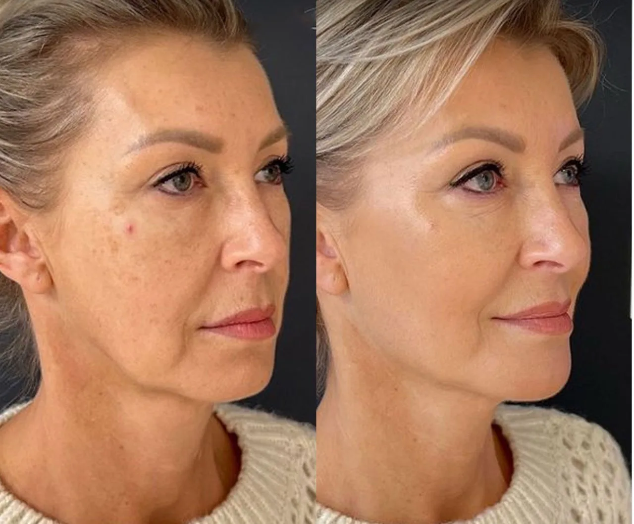 XERF side profile before and after - skin tone and texture improvement