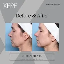 XERF before and after - 2 treatments side profile - Cynosure clinical
