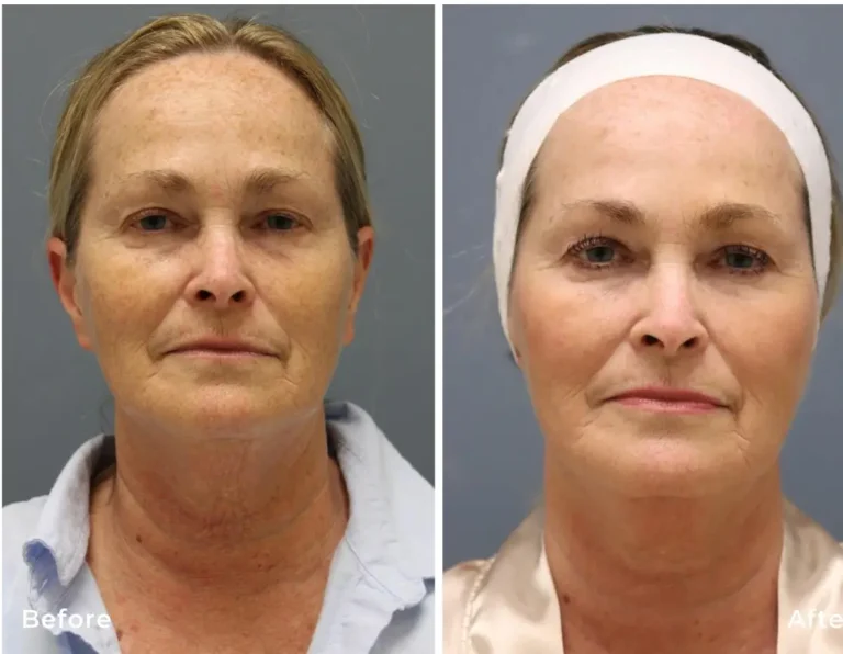 Radiofrequency microneedling before and after